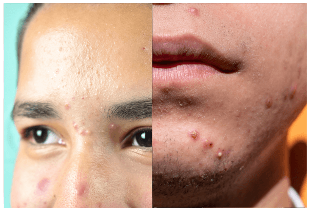 Dermal Fillers in Lucknow